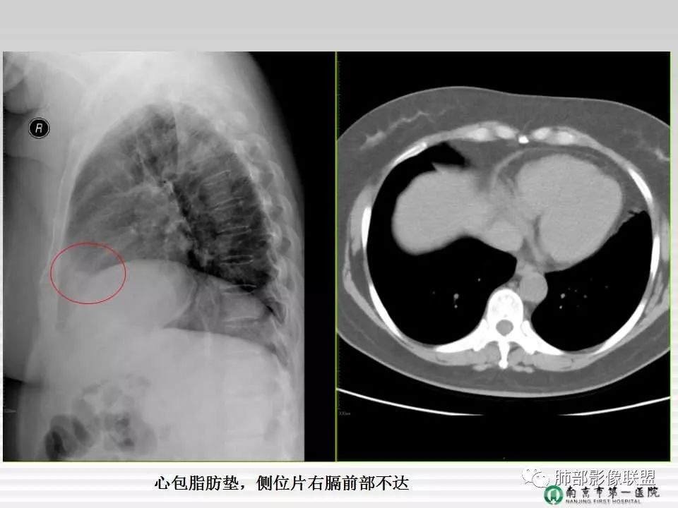 【PPT】胸片中的界与线——识别隐匿者与伪装者