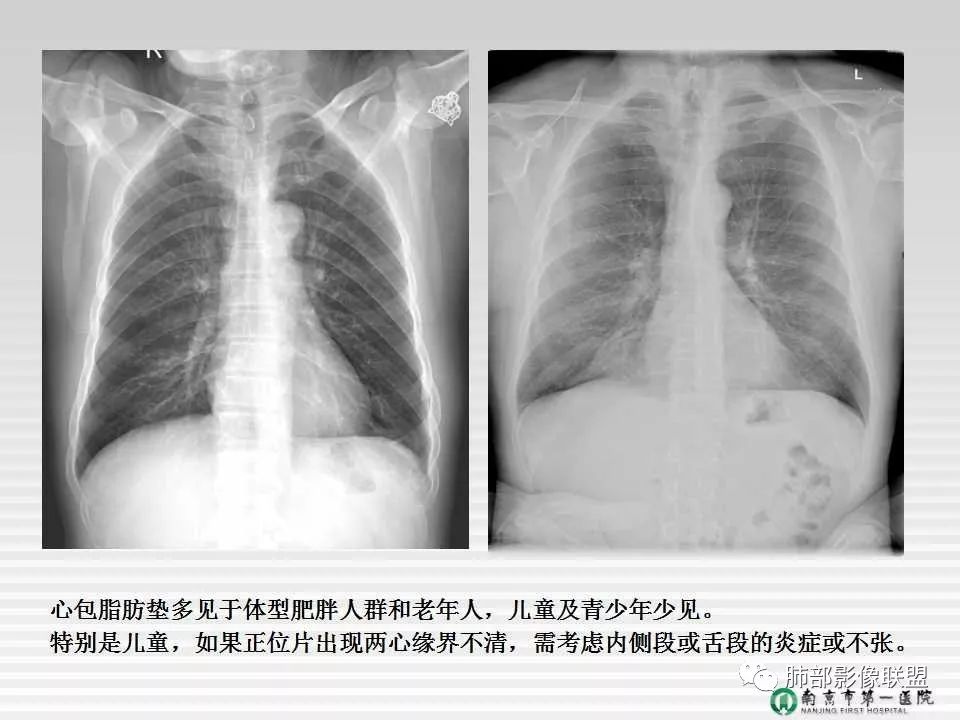 【PPT】胸片中的界与线——识别隐匿者与伪装者