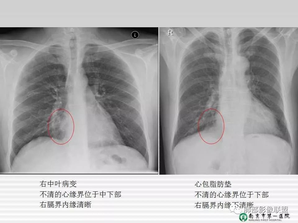 【PPT】胸片中的界与线——识别隐匿者与伪装者