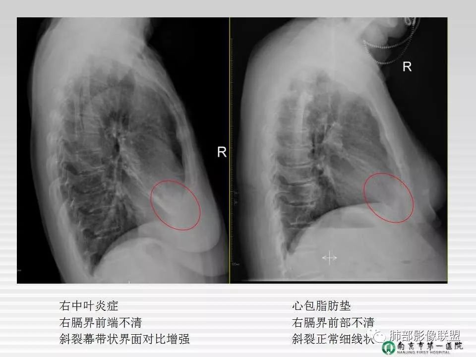 【PPT】胸片中的界与线——识别隐匿者与伪装者