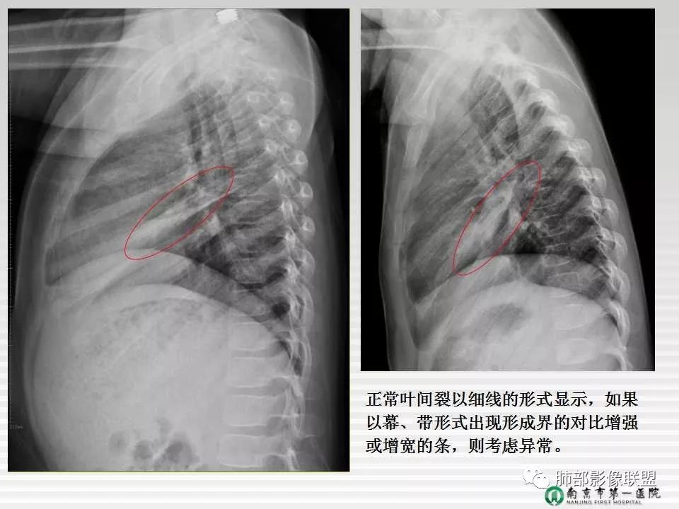【PPT】胸片中的界与线——识别隐匿者与伪装者