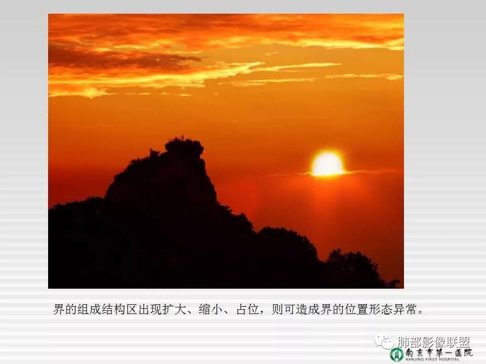 【PPT】胸片中的界与线——识别隐匿者与伪装者