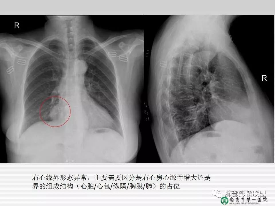 【PPT】胸片中的界与线——识别隐匿者与伪装者