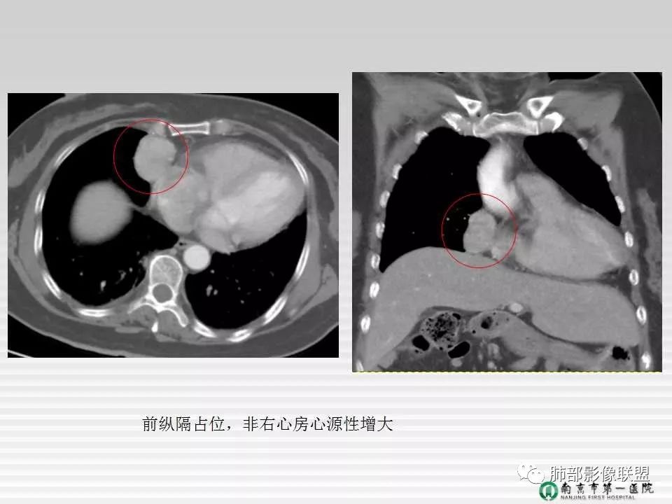 【PPT】胸片中的界与线——识别隐匿者与伪装者