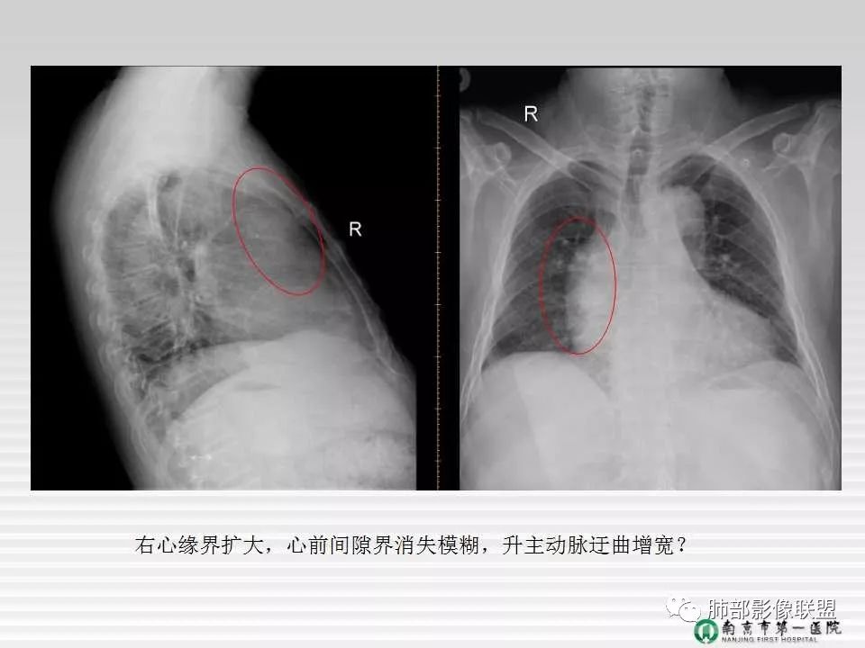 【PPT】胸片中的界与线——识别隐匿者与伪装者