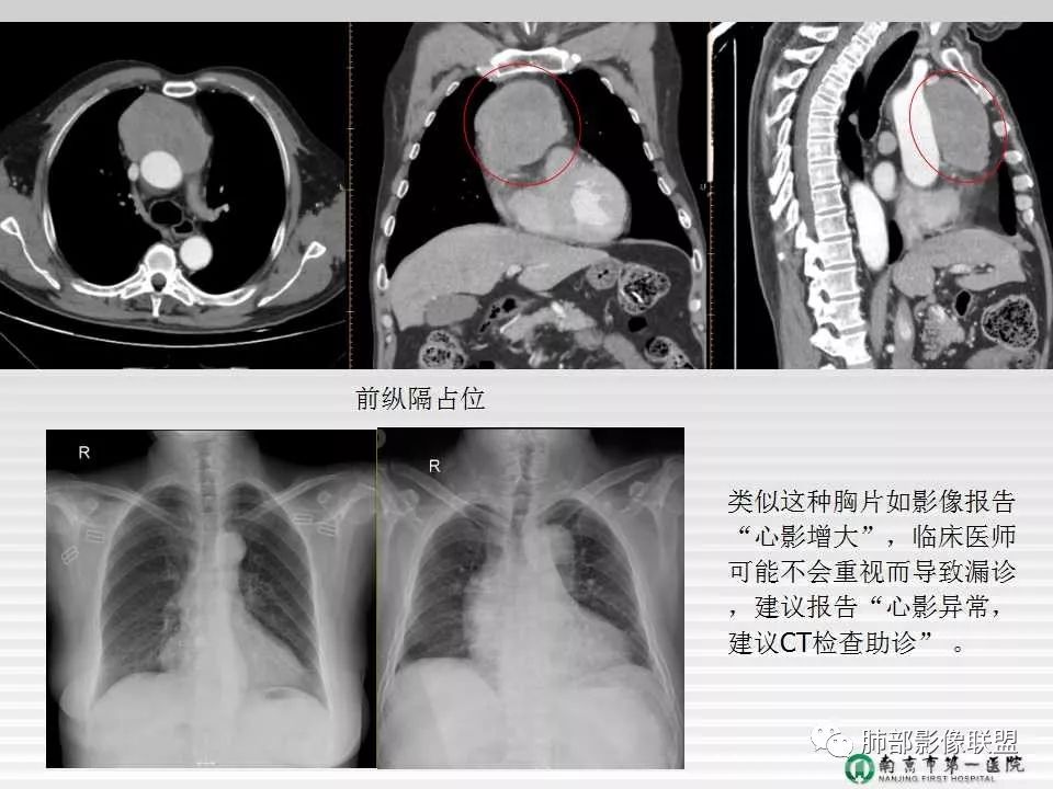 【PPT】胸片中的界与线——识别隐匿者与伪装者