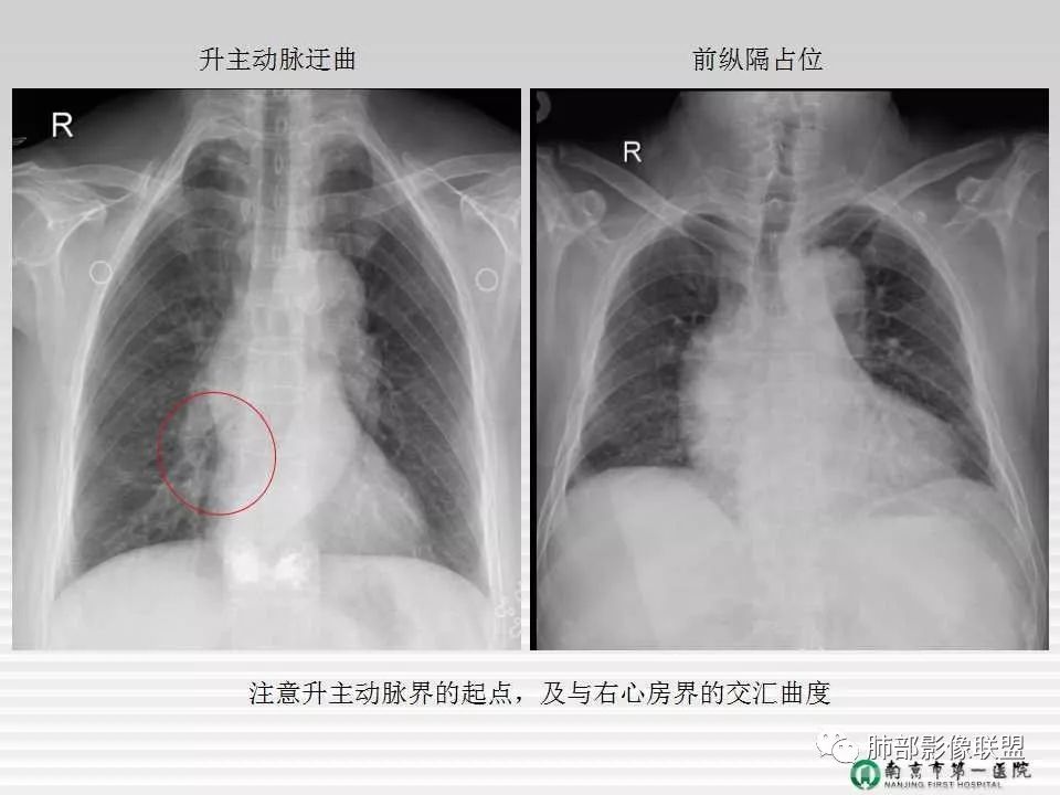 【PPT】胸片中的界与线——识别隐匿者与伪装者