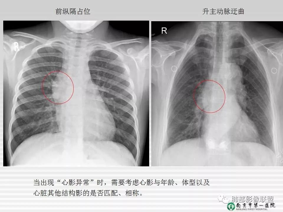 【PPT】胸片中的界与线——识别隐匿者与伪装者