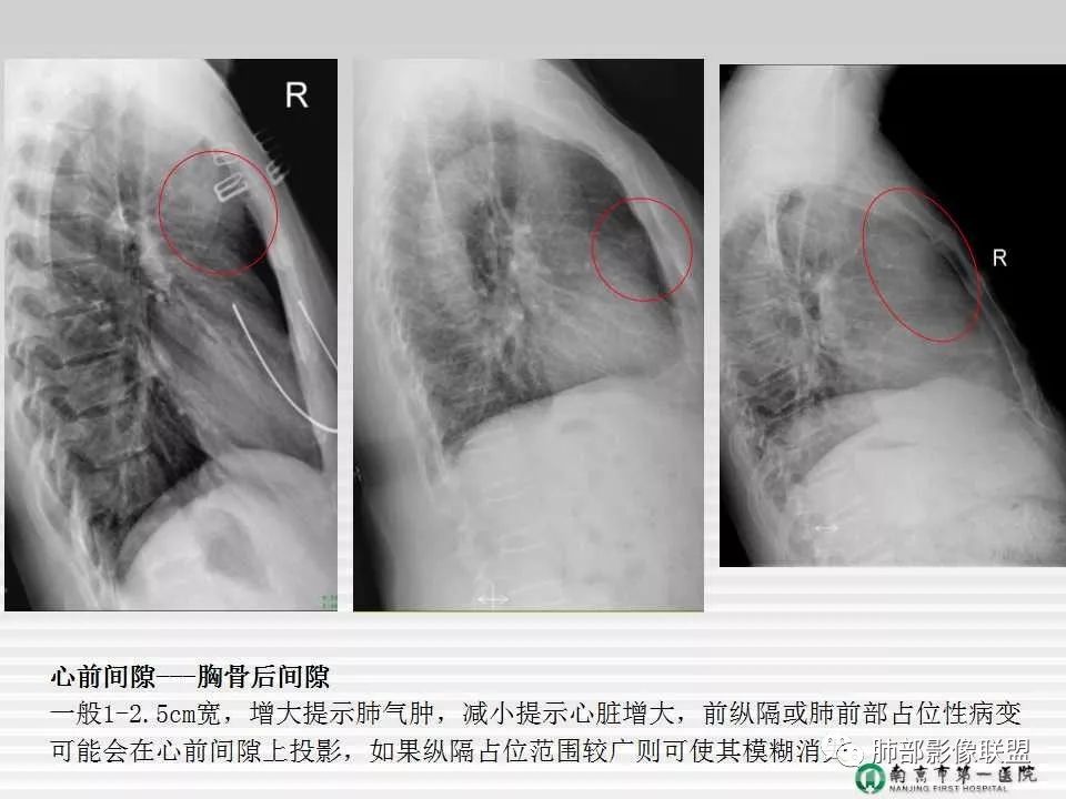 【PPT】胸片中的界与线——识别隐匿者与伪装者