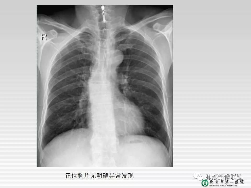 【PPT】胸片中的界与线——识别隐匿者与伪装者