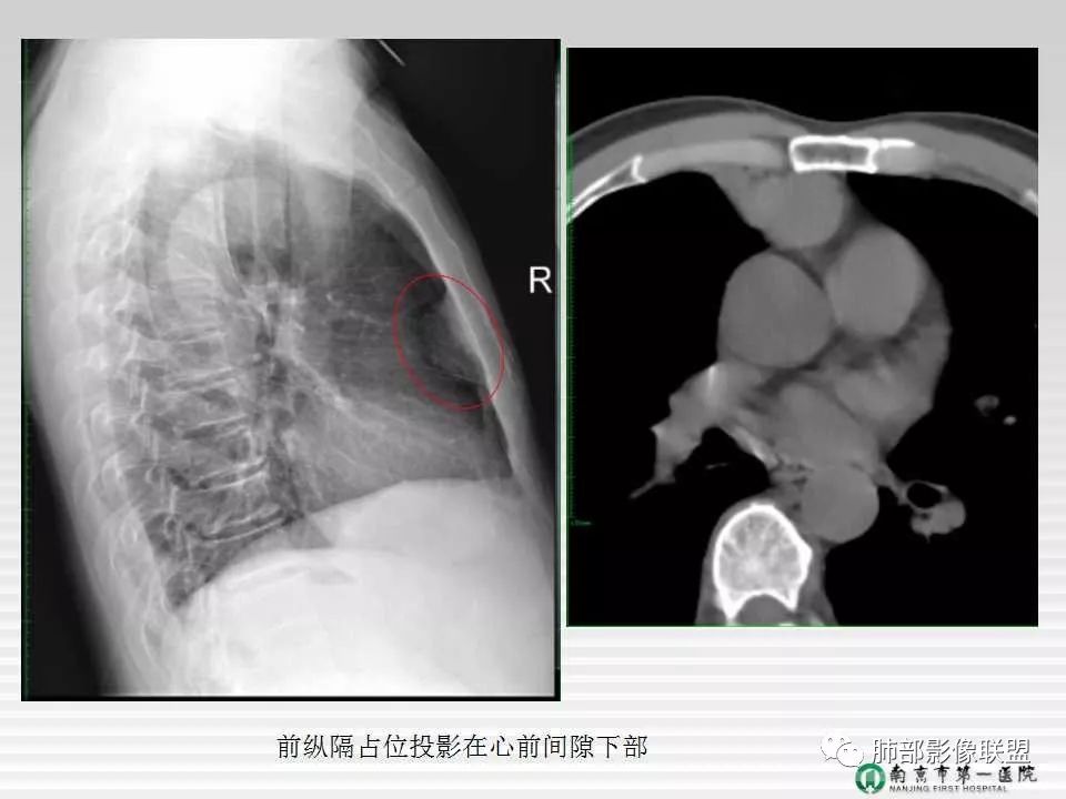 【PPT】胸片中的界与线——识别隐匿者与伪装者
