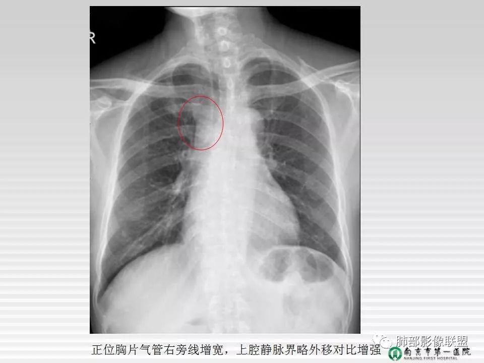 【PPT】胸片中的界与线——识别隐匿者与伪装者
