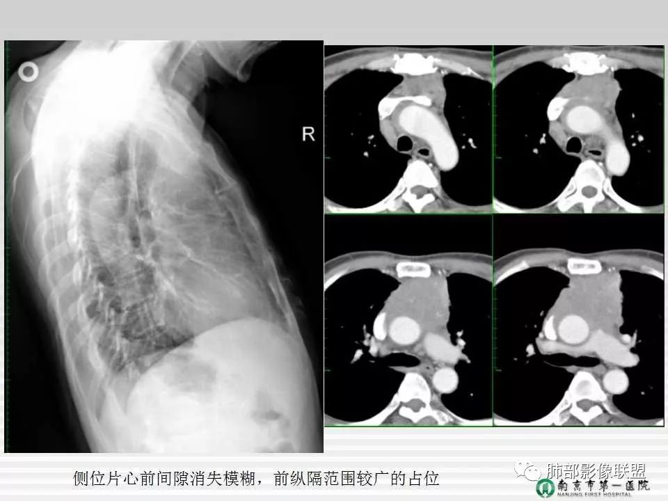 【PPT】胸片中的界与线——识别隐匿者与伪装者