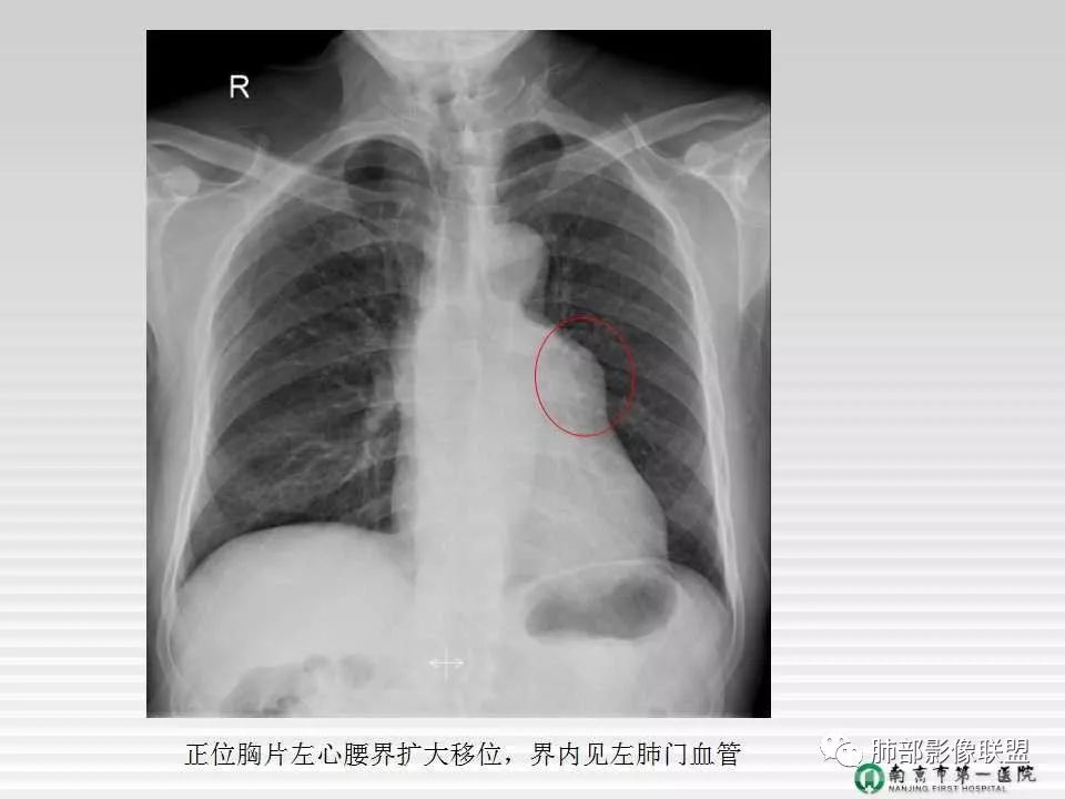 【PPT】胸片中的界与线——识别隐匿者与伪装者