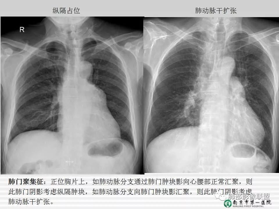 【PPT】胸片中的界与线——识别隐匿者与伪装者