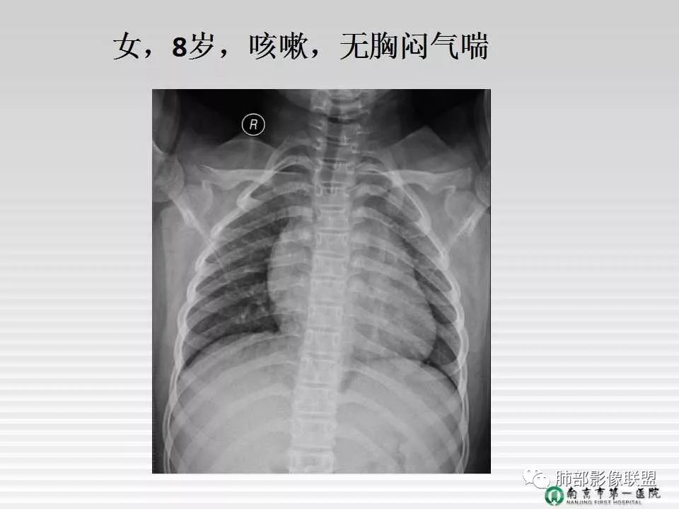 【PPT】胸片中的界与线——识别隐匿者与伪装者