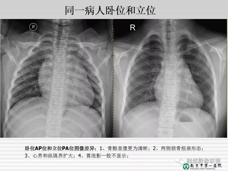 【PPT】胸片中的界与线——识别隐匿者与伪装者