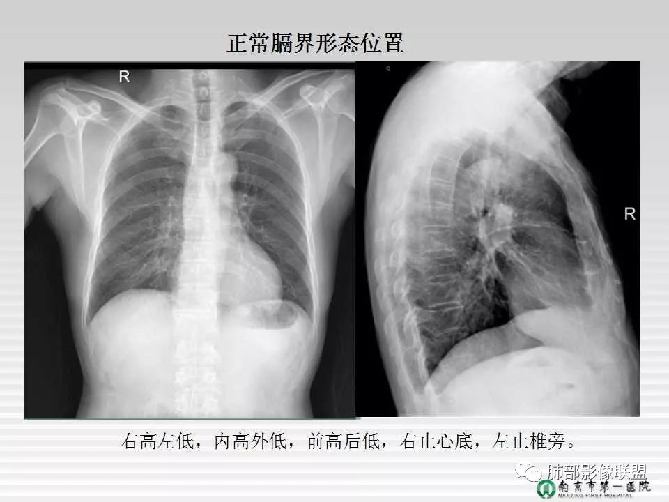 【PPT】胸片中的界与线——识别隐匿者与伪装者