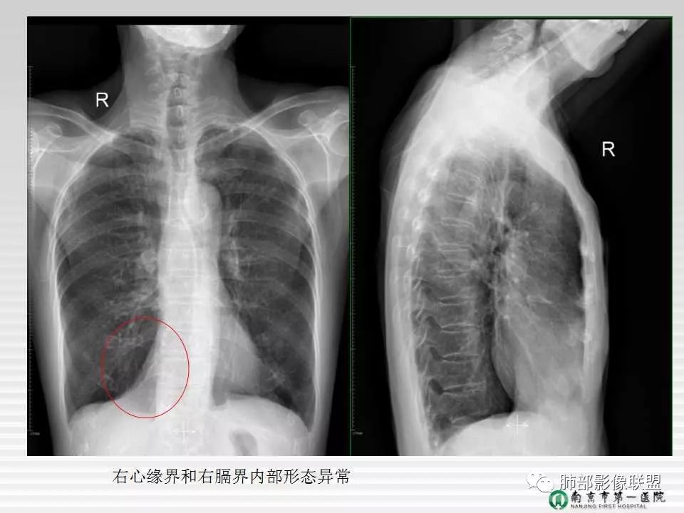 【PPT】胸片中的界与线——识别隐匿者与伪装者