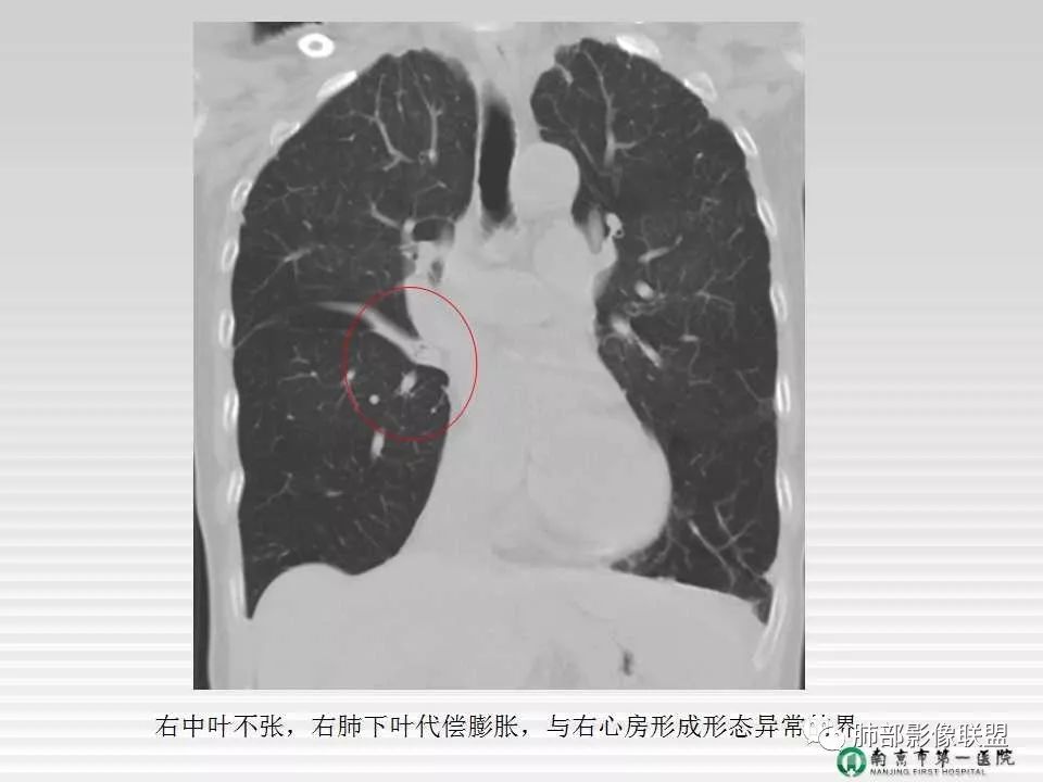 【PPT】胸片中的界与线——识别隐匿者与伪装者