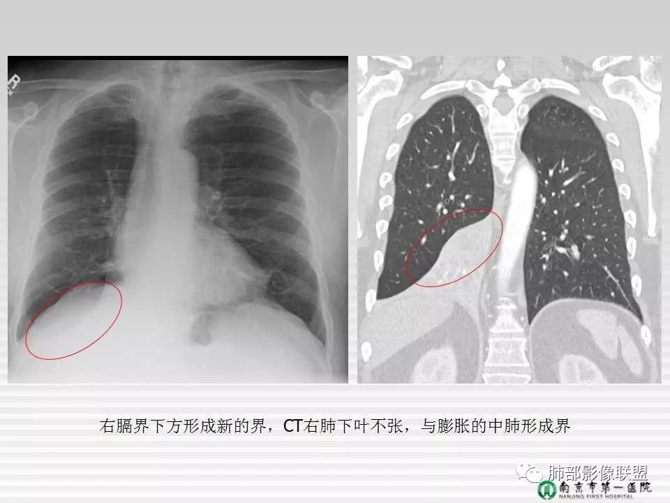 【PPT】胸片中的界与线——识别隐匿者与伪装者