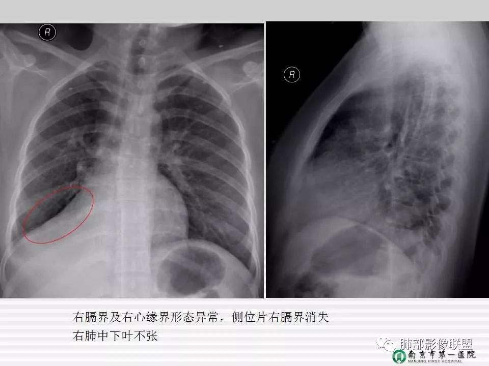 【PPT】胸片中的界与线——识别隐匿者与伪装者