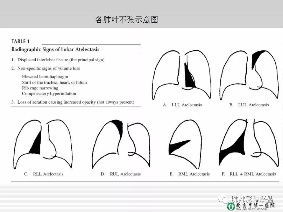 【PPT】胸片中的界与线——识别隐匿者与伪装者