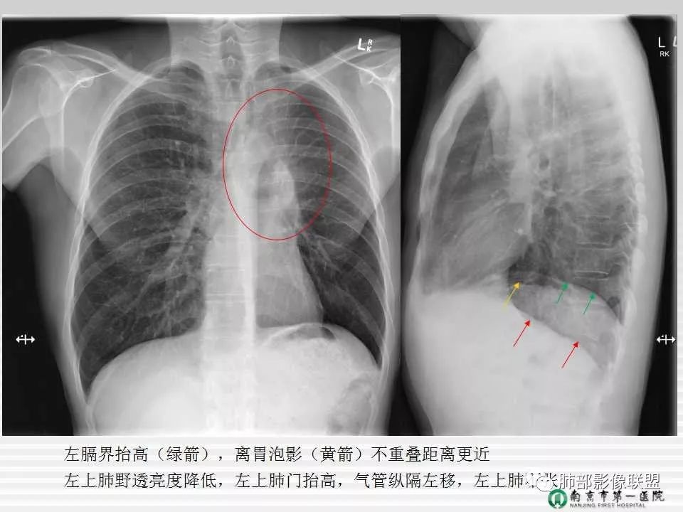 【PPT】胸片中的界与线——识别隐匿者与伪装者