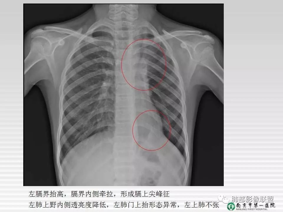 【PPT】胸片中的界与线——识别隐匿者与伪装者