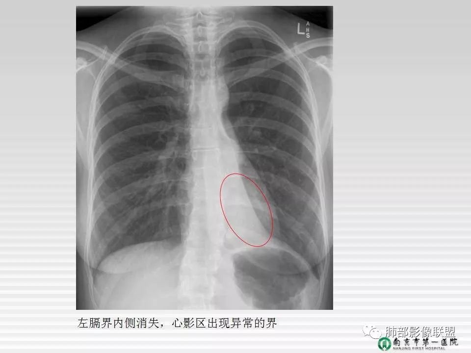 【PPT】胸片中的界与线——识别隐匿者与伪装者
