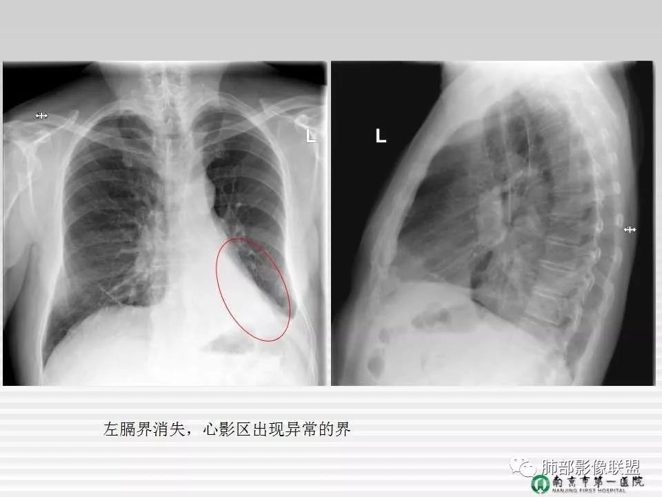 【PPT】胸片中的界与线——识别隐匿者与伪装者