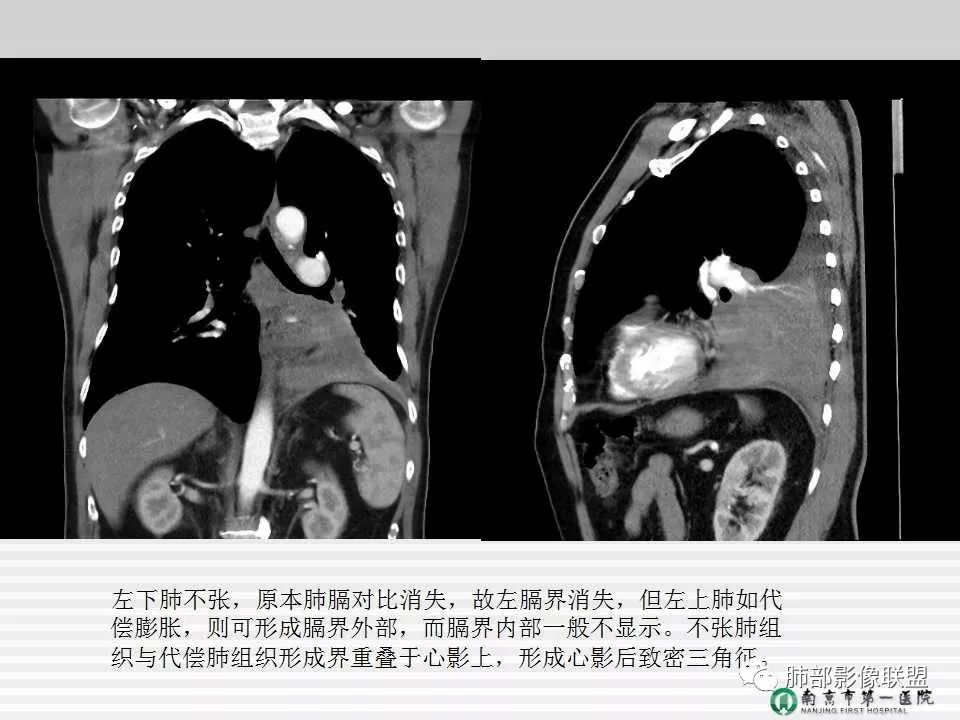 【PPT】胸片中的界与线——识别隐匿者与伪装者