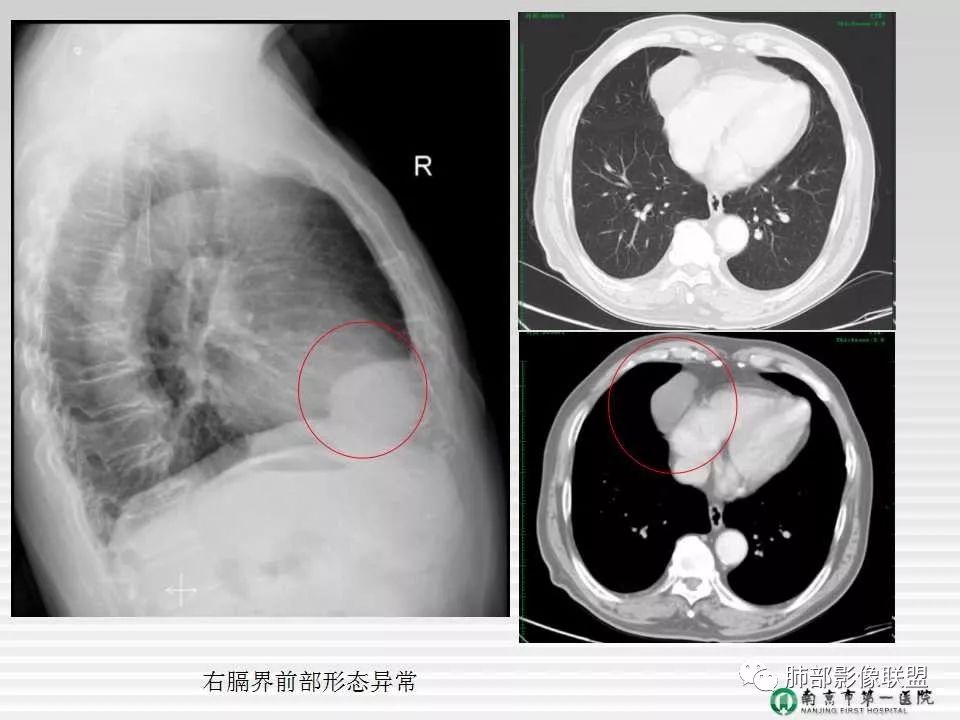 【PPT】胸片中的界与线——识别隐匿者与伪装者