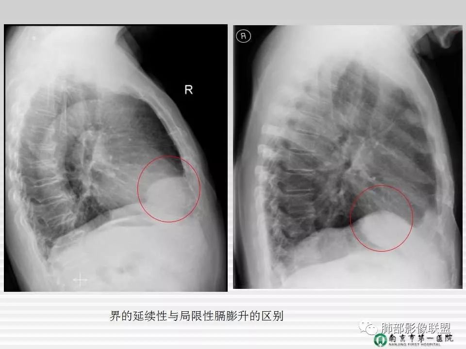 【PPT】胸片中的界与线——识别隐匿者与伪装者