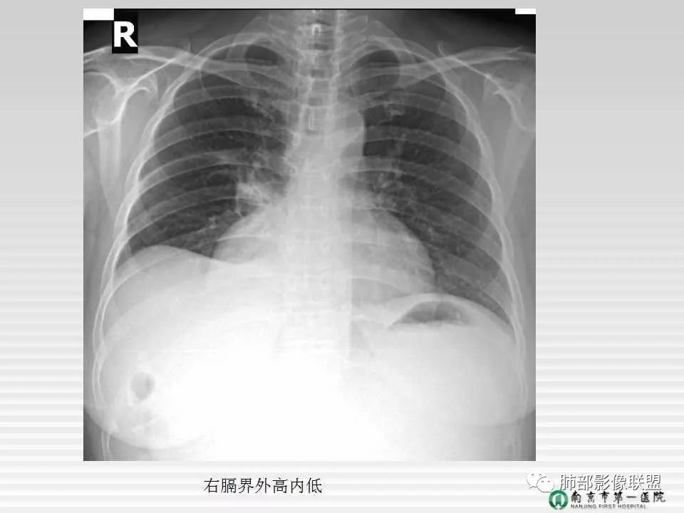 【PPT】胸片中的界与线——识别隐匿者与伪装者