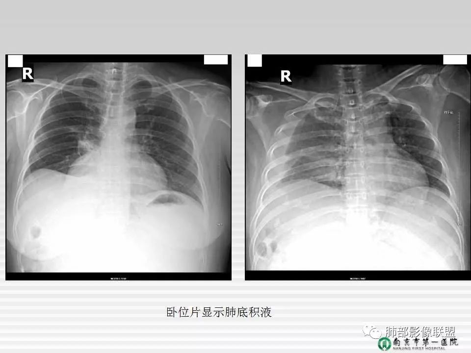 【PPT】胸片中的界与线——识别隐匿者与伪装者