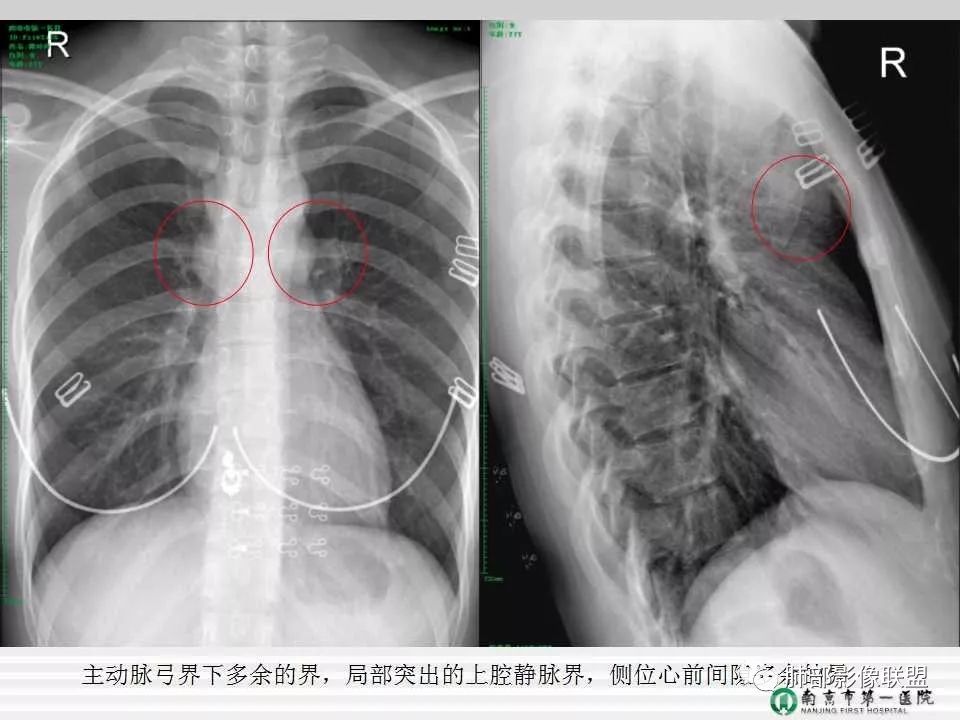 【PPT】胸片中的界与线——识别隐匿者与伪装者
