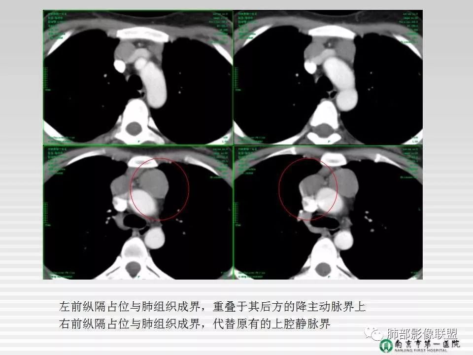 【PPT】胸片中的界与线——识别隐匿者与伪装者