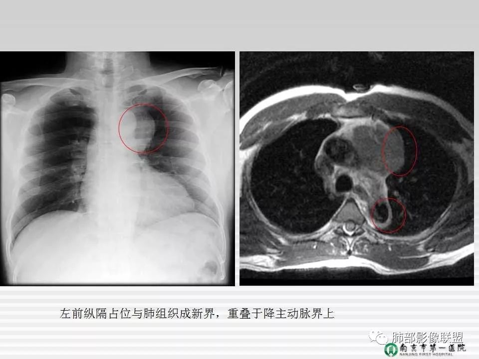 【PPT】胸片中的界与线——识别隐匿者与伪装者