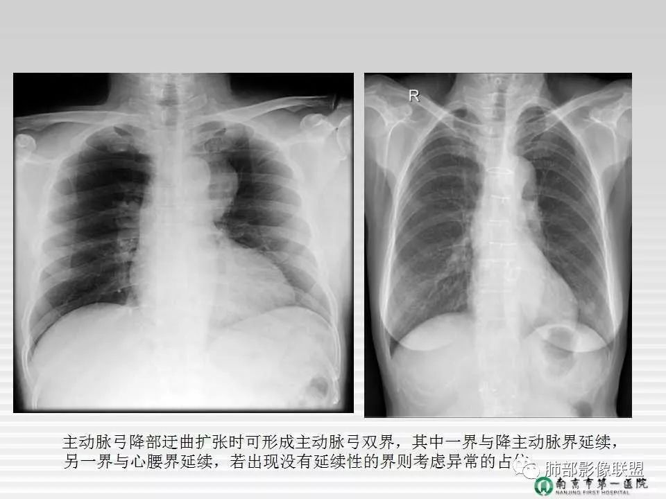 【PPT】胸片中的界与线——识别隐匿者与伪装者