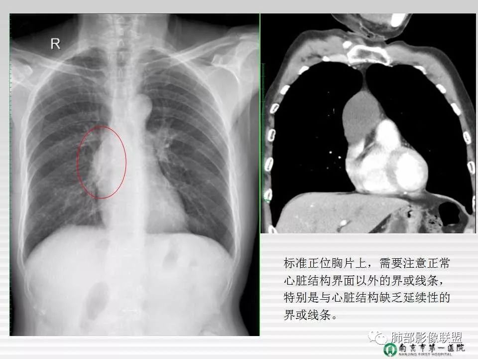 【PPT】胸片中的界与线——识别隐匿者与伪装者