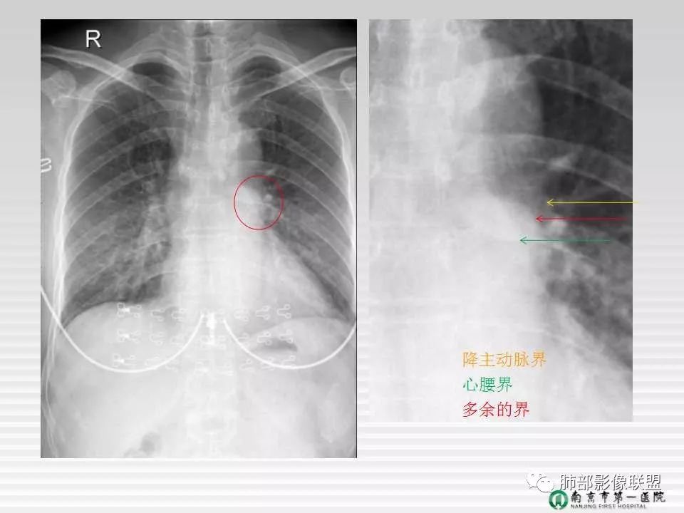【PPT】胸片中的界与线——识别隐匿者与伪装者