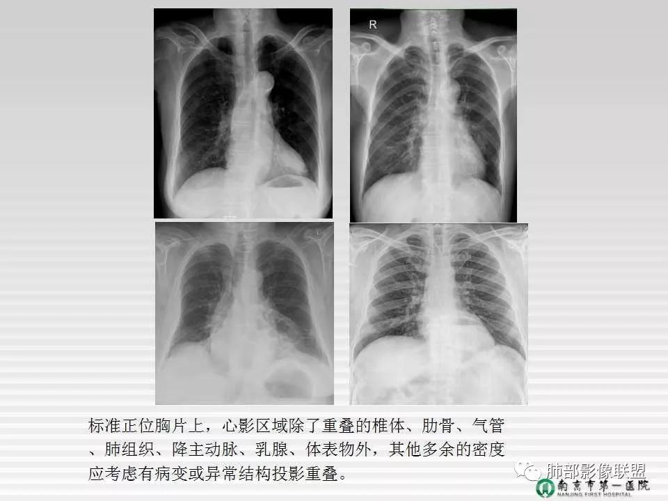 【PPT】胸片中的界与线——识别隐匿者与伪装者