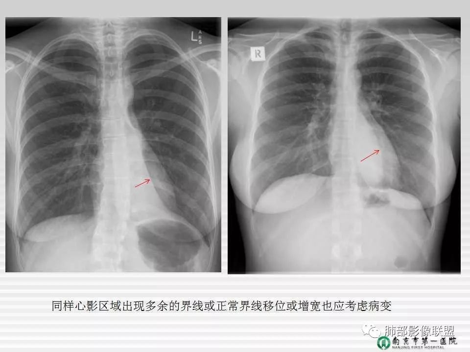 【PPT】胸片中的界与线——识别隐匿者与伪装者