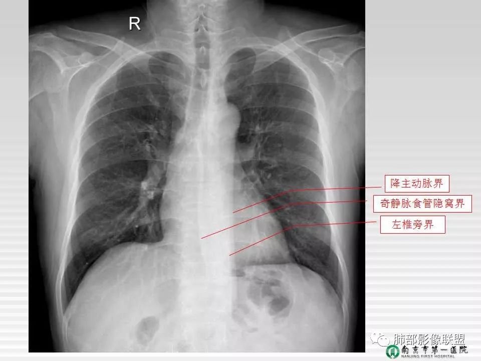 【PPT】胸片中的界与线——识别隐匿者与伪装者