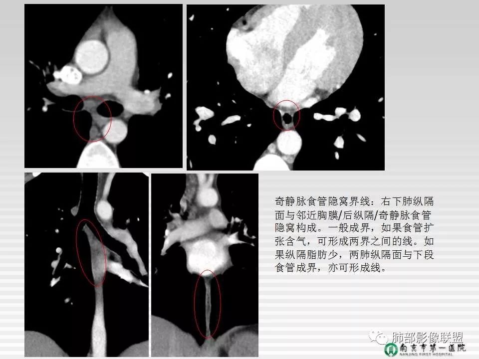 【PPT】胸片中的界与线——识别隐匿者与伪装者