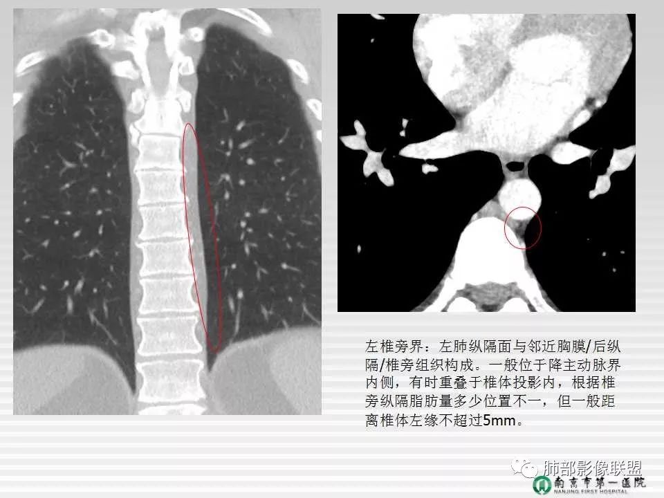 【PPT】胸片中的界与线——识别隐匿者与伪装者