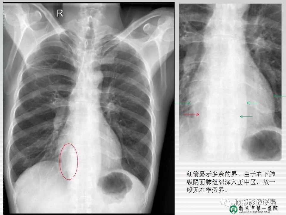 【PPT】胸片中的界与线——识别隐匿者与伪装者