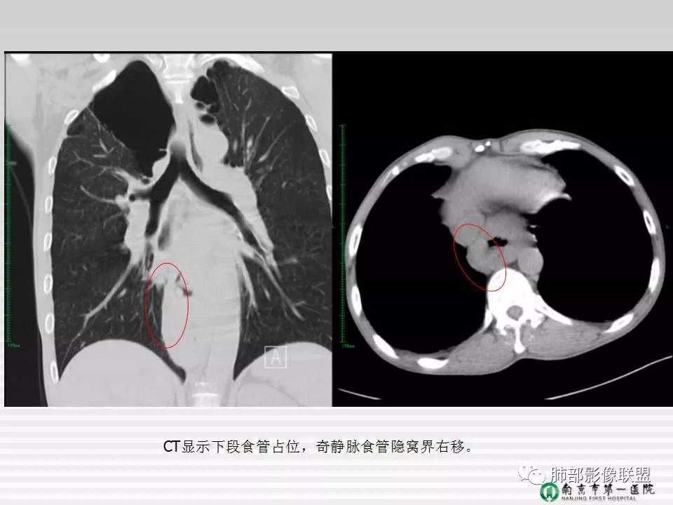 【PPT】胸片中的界与线——识别隐匿者与伪装者