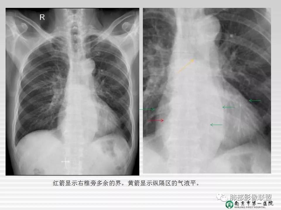 【PPT】胸片中的界与线——识别隐匿者与伪装者